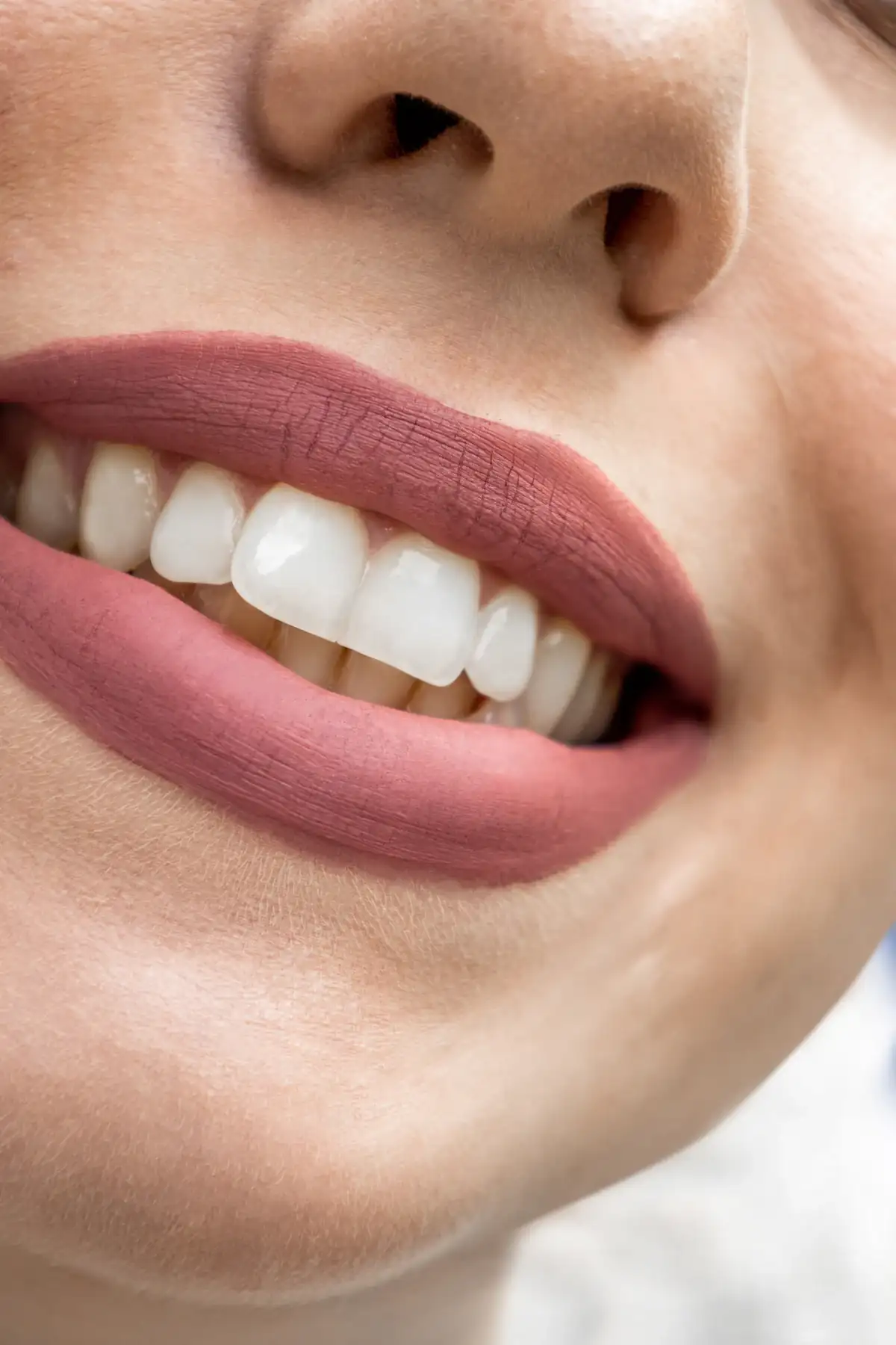 After: a bright, even smile following whitening and bonding